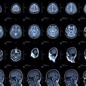 脑彩超 和脑CT有什么区别？