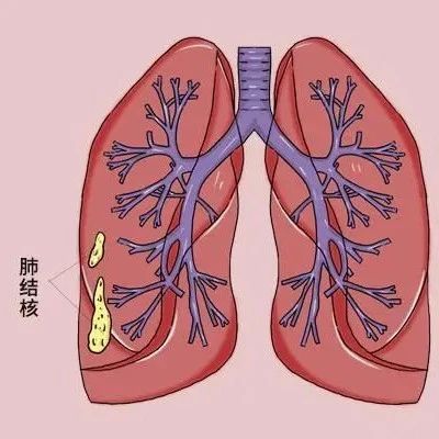 肺部ct什么时候出结果，