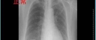 肺ct怎么检查的，肺ct怎么做的