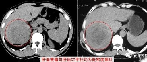 肝癌患者治疗得学会省着花钱