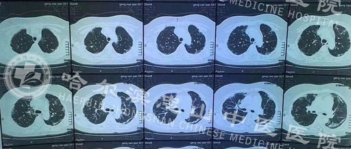 如何看ct片子肺部，如何看ct片子肺部感染图片